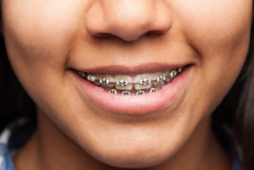 Zobni aparat: prikaz ortodonta pri delu in primer nevidnega zobnega aparata Invisalign na nasmehu odraslega pacienta.
